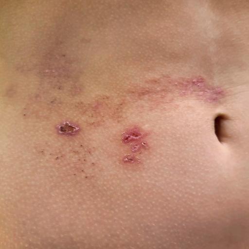 Bei einer Gürtelrose ist immer nur eine Hautpartie befallen – warum?