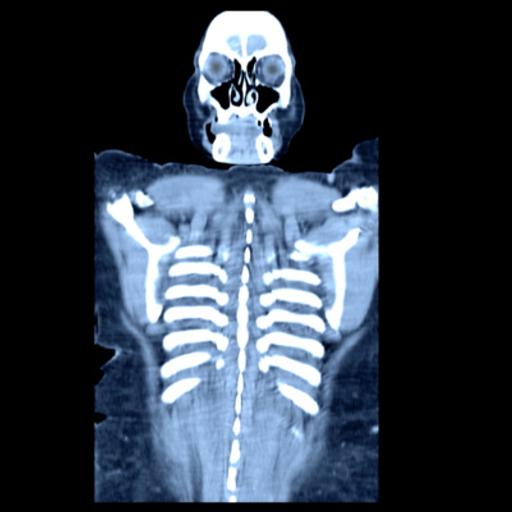 A Woman Ate 23 Bananas After Fasting 7 Days And Had Refeeding Syndrome