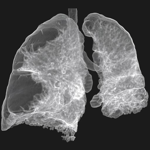 USPSTF Recommendation: Screening for Chronic Obstructive Pulmonary Disease