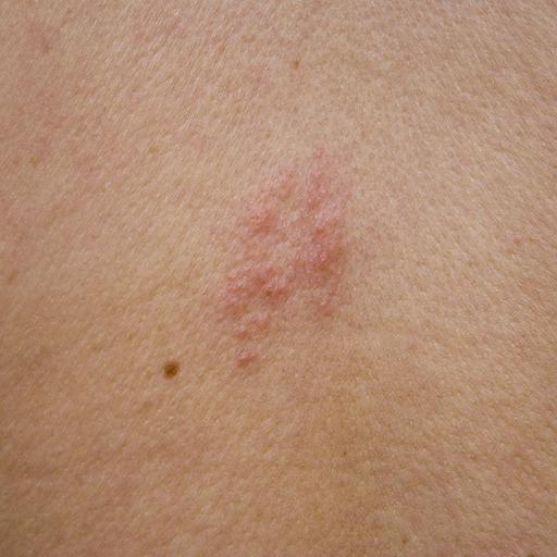 Shingles Podcast