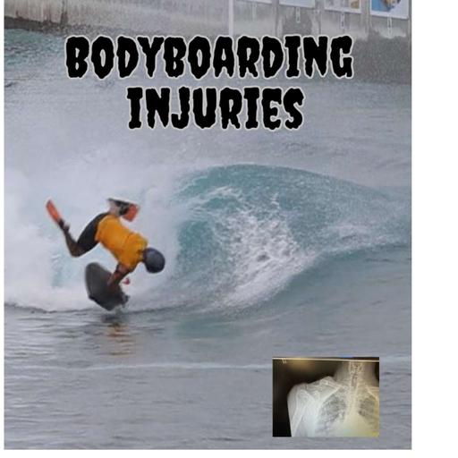 The Reale Deal Show #106- Bodyboarding injuries
