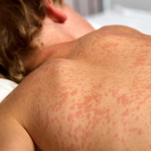 Canada has a measles problem