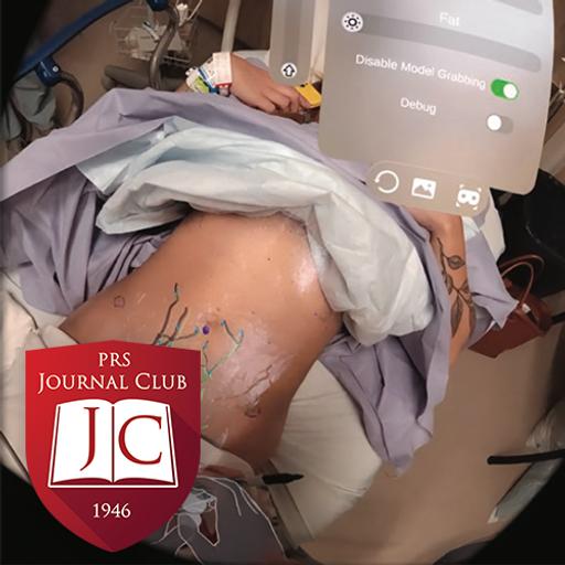 “Augmented Reality for DIEP Flaps” with Chris Campbell, MD - Jun. 2025 Journal Club
