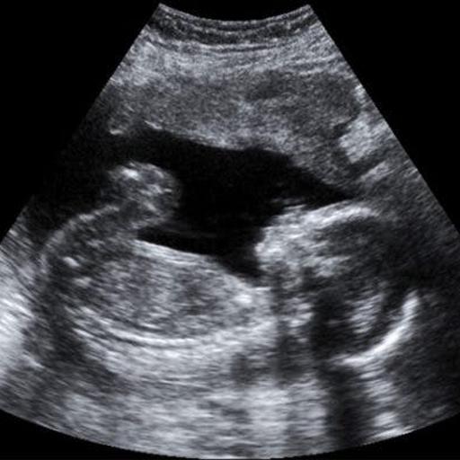 Vanishing Twin Syndrome