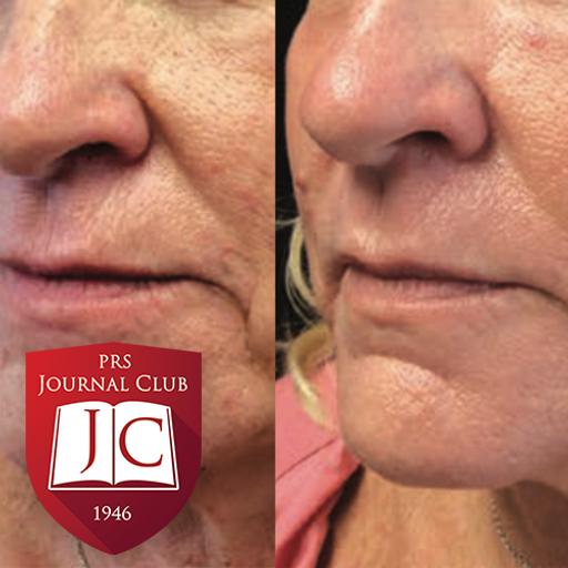 “PROs after Facial Laser Resurfacing” with Lara Devgan, MD, MPH - Jul. 2025 Journal Club
