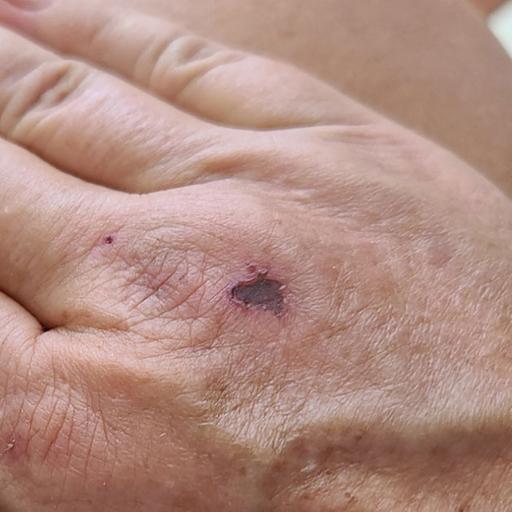 Caring for Minor Injuries During Boat Projects