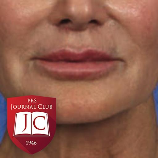 “Model for Lip Lift Counseling” with Lara Devgan, MD, MPH - Jul. 2025 Journal Club