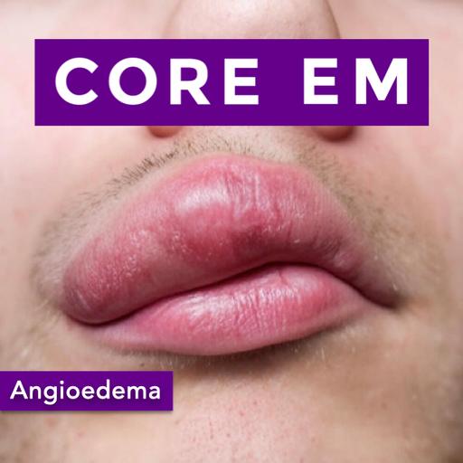 Episode 212: Angioedema