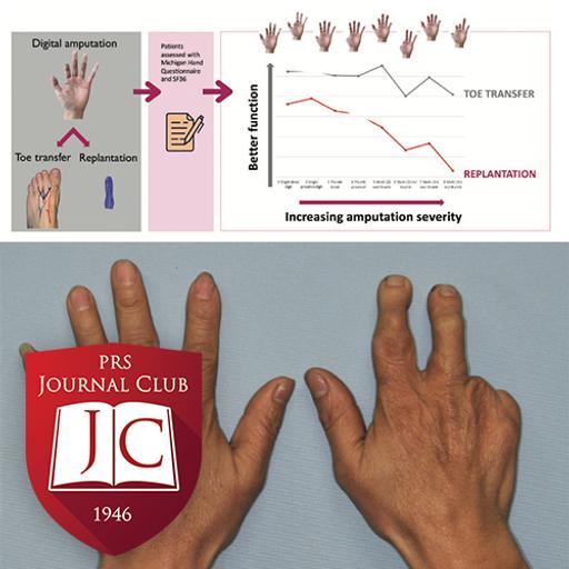 “Toe Transfers Outperform Replantation” with James Higgins, MD - Aug. 2025 Journal Club