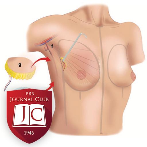 “NSM with IBR” with Jesse Selber, MD - Sept. 2025 Journal Club