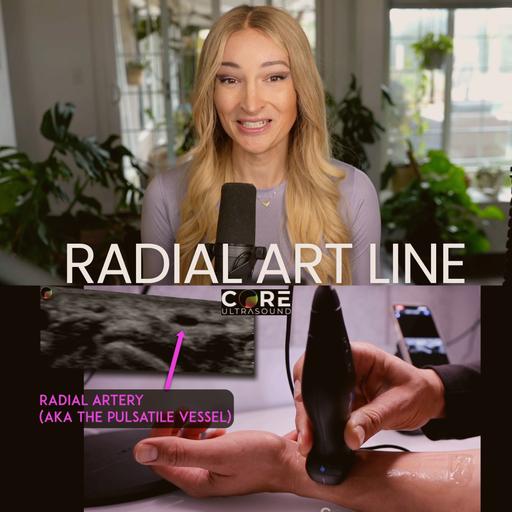 How to Place Arterial Catheters Using POCUS