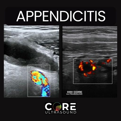 Appendicitis Diagnosis with Ultrasound