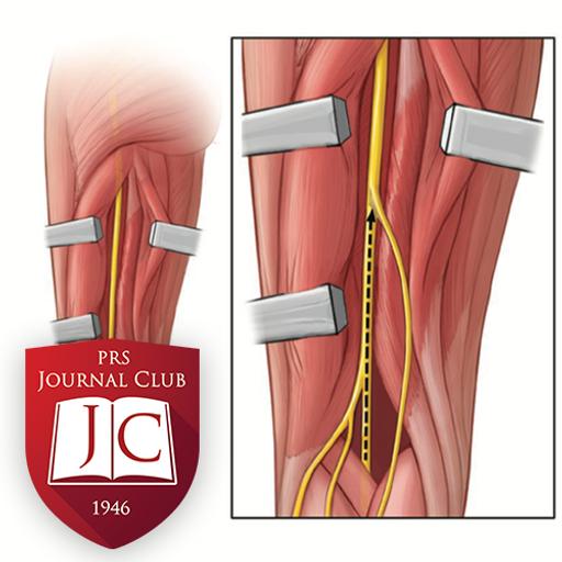 "Extended Sural Nerve Harvest" with Shai Rozen, MD - Jan. 2026 Journal Club
