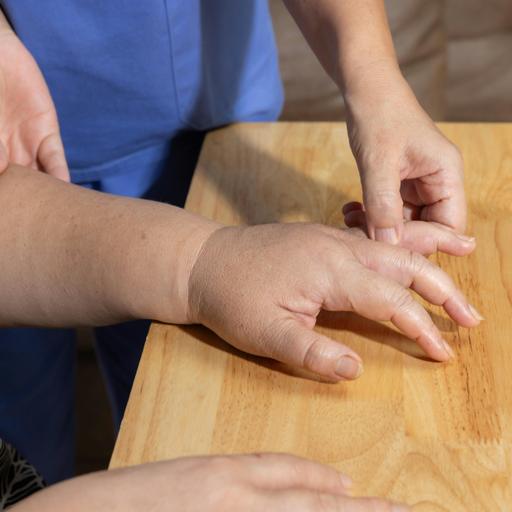 Can GLP-1s Treat Lymphedema?