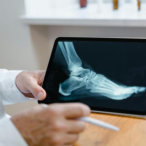 Can You Run After Multiple Fifth Metatarsal Fractures And Osteoporosis?