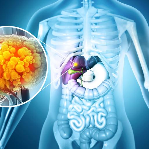 EKU Podcast: Fatty liver disease