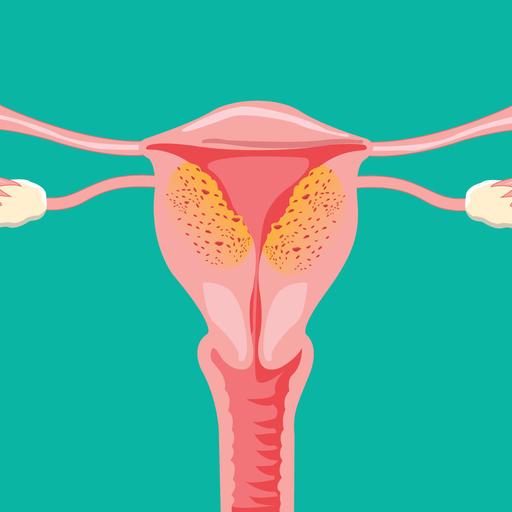EKU Podcast: Adenomyosis & Endometriosis