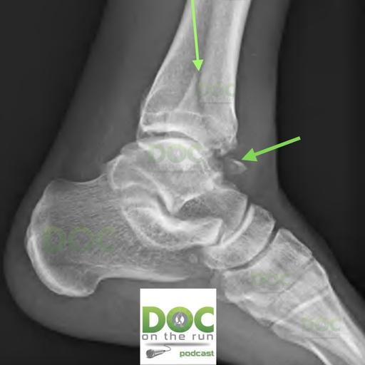 He Passed the Ankle Fracture Test...But His Ankle Was Broken!
